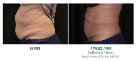 after coolsculpting.